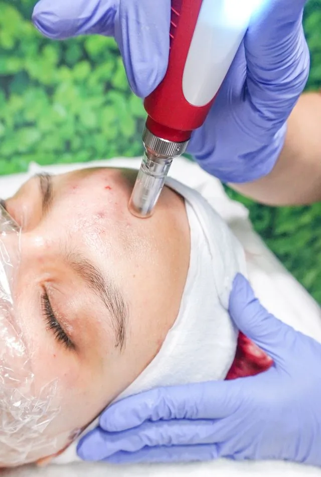 Microneedling facials